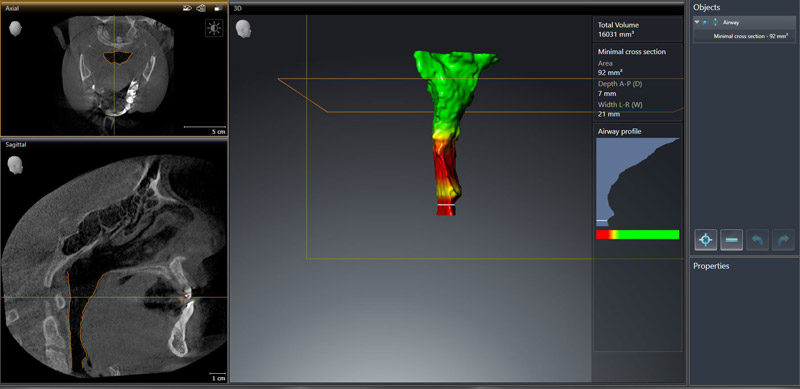 Cone Beam Imaging Airway Mapping