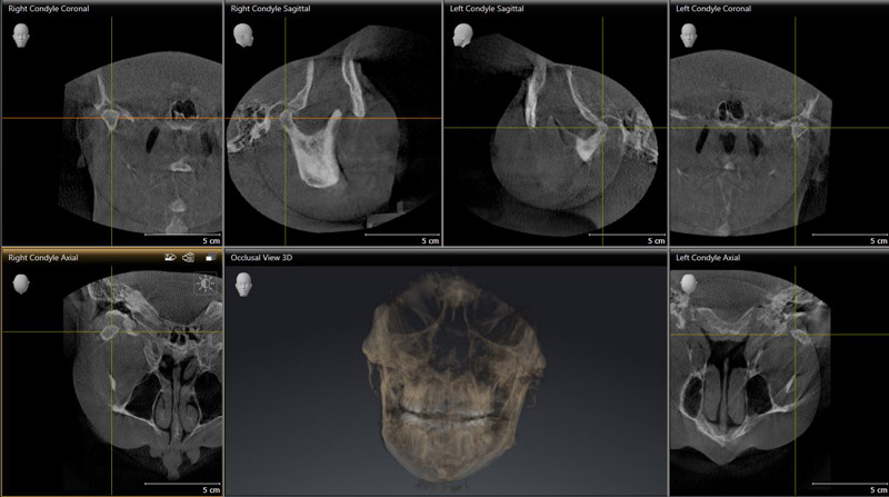 Cone Beam Imaging TMJ X-Rays